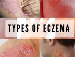 Apa Itu Eksim? Penyakit Kulit Kronis yang Wajib Diketahui