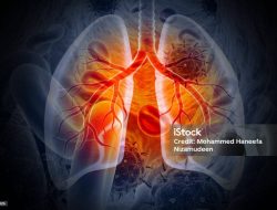 Apa Itu TBC? Jawaban Lengkapnya